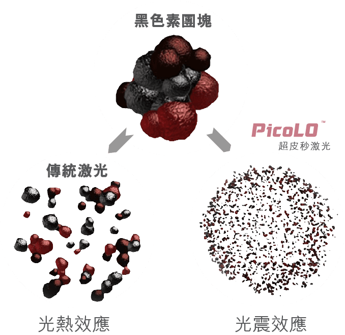 皮秒粉碎黑色素示意