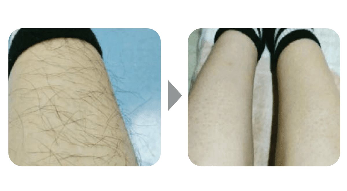 冰感激光脫毛腿部示意