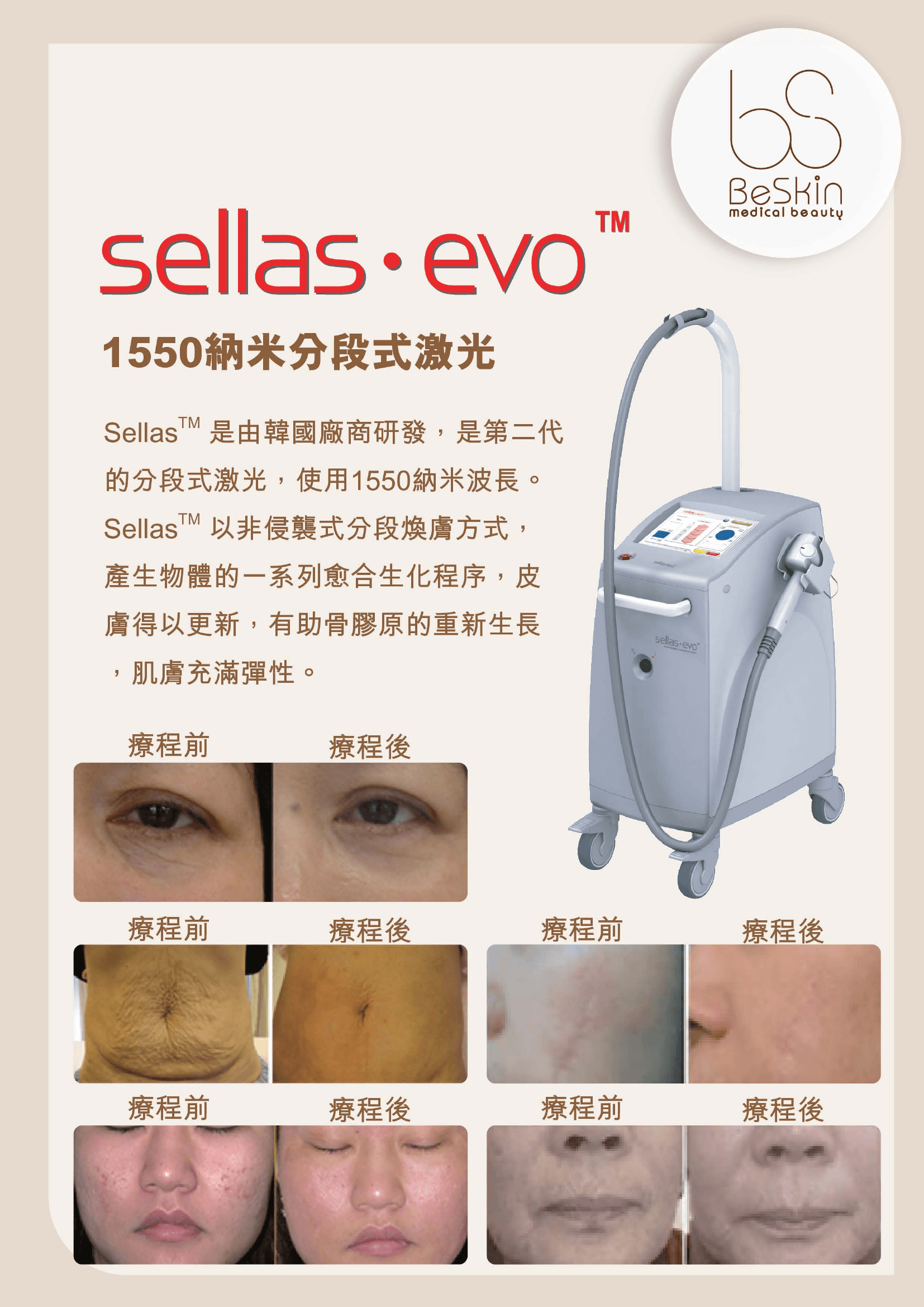 sellas evo 微點激光儀器