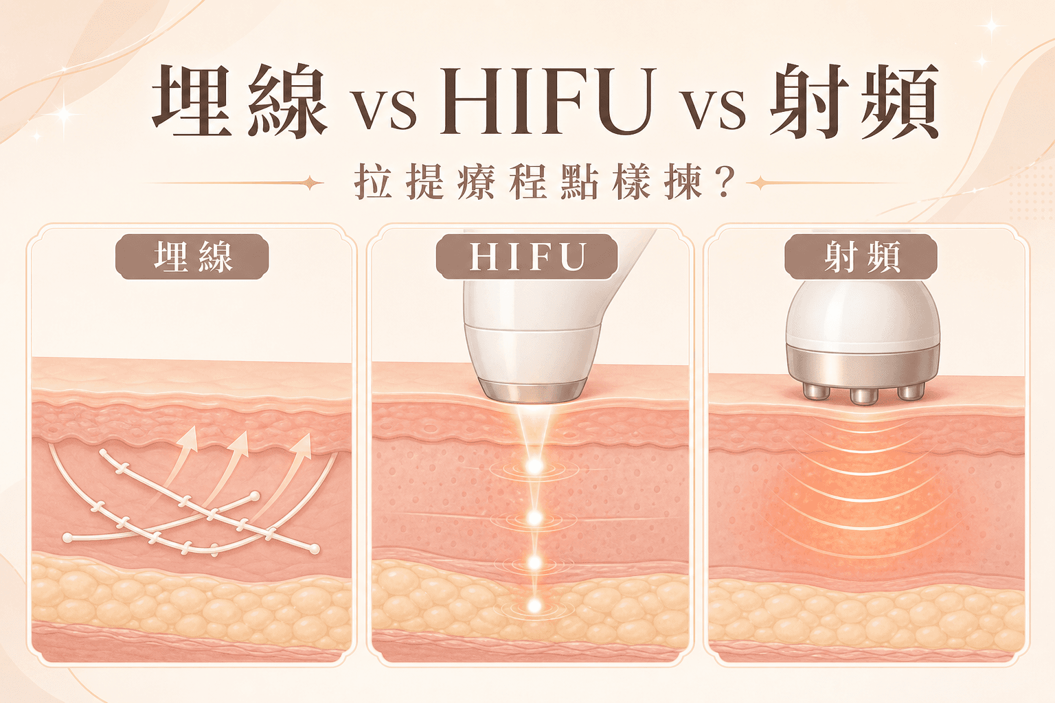 面部埋線 HIFU 微聚焦超聲波與射頻緊膚比較插畫